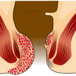 hemotera wasir derajat 4