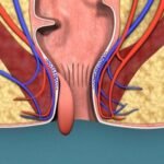 hemotera bahaya wasir stadium 4