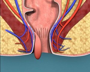 hemotera bahaya wasir stadium 4