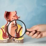 hemotera kanker rektum