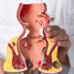 hemotera ciri fisik ambeien