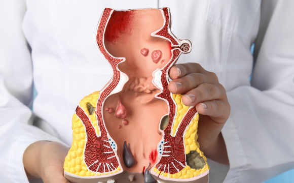 hemotera ciri fisik ambeien