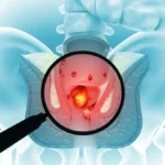 hemotera gejala wasir stadium 2