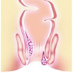 hemotera wasir stadium 3