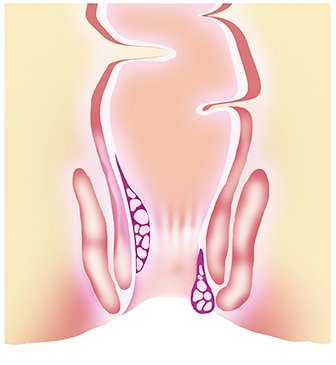 hemotera wasir stadium 3