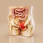 hemotera 4 stadium wasir