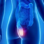 hemotera 4 stadium wasir