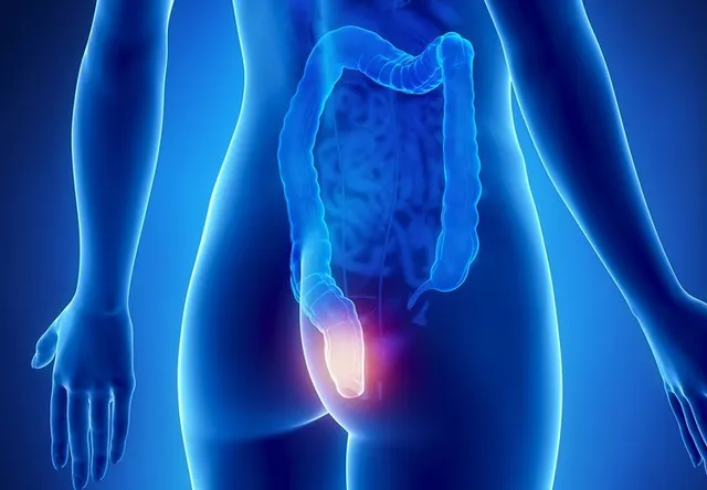 hemotera 4 stadium wasir