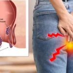 hemotera nyeri dubur tak tertahankan