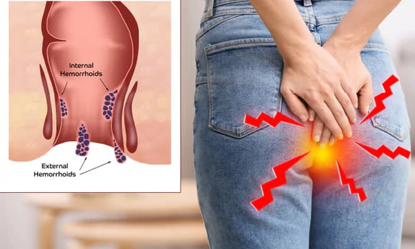 hemotera nyeri dubur tak tertahankan