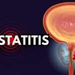 prosterafit cara mengatasi prostatitis kronis