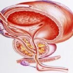 prosterafit peradangan prostat kronis