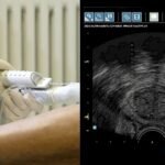 prosterafit mengukur volume prostat