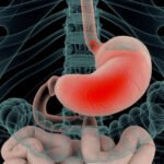 soluma dampak asam lambung kronis