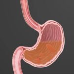 soluma tanda luka lambung