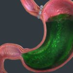 soluma cairan lambung