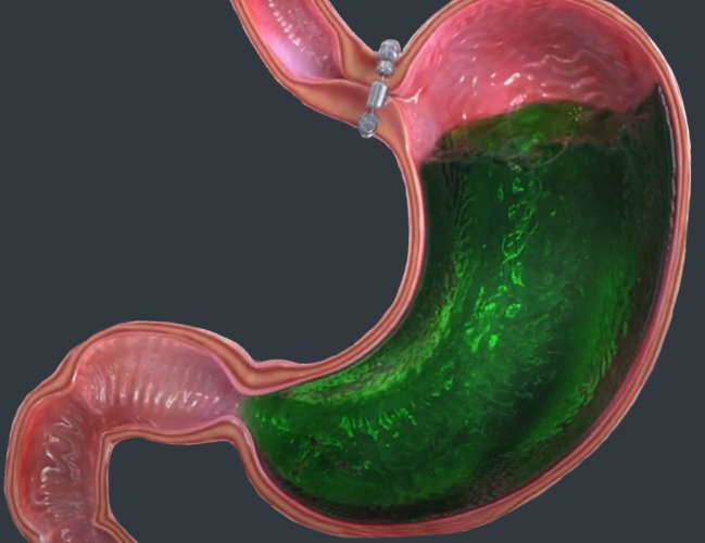 soluma cairan lambung