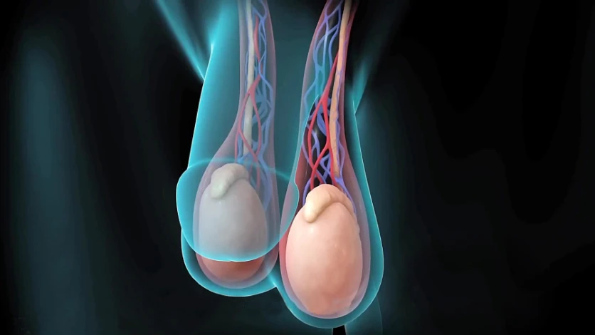 vertomen varikokel membuat pria mandul