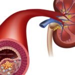 Kenali gejala darah tainggi sebelum stroke