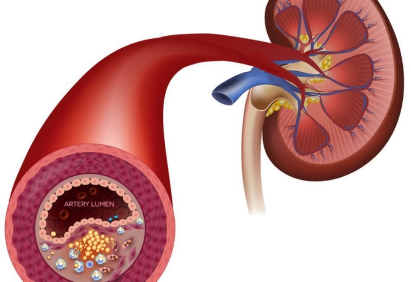 Kenali gejala darah tainggi sebelum stroke