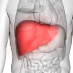 Pengobatan Fatty Liver tanpa Harus Bergantung Obat Kimia