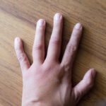 afiapro cara mengatasi pembengkakan sendi