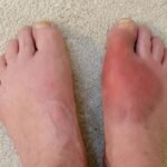 afiapro penyakit gout