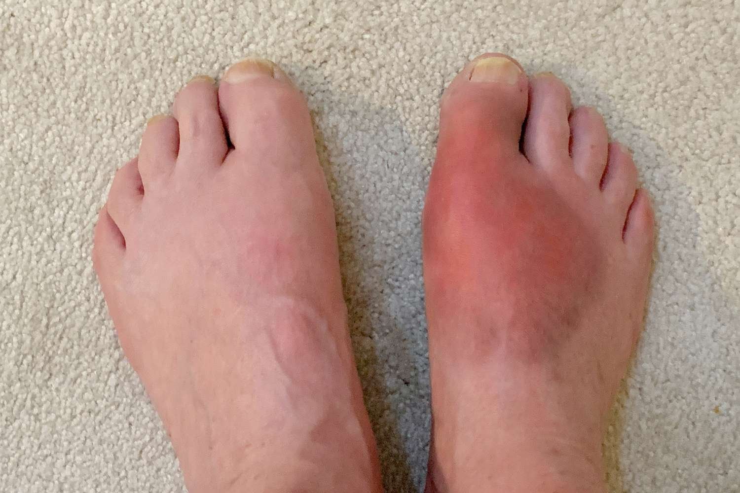 afiapro penyakit gout