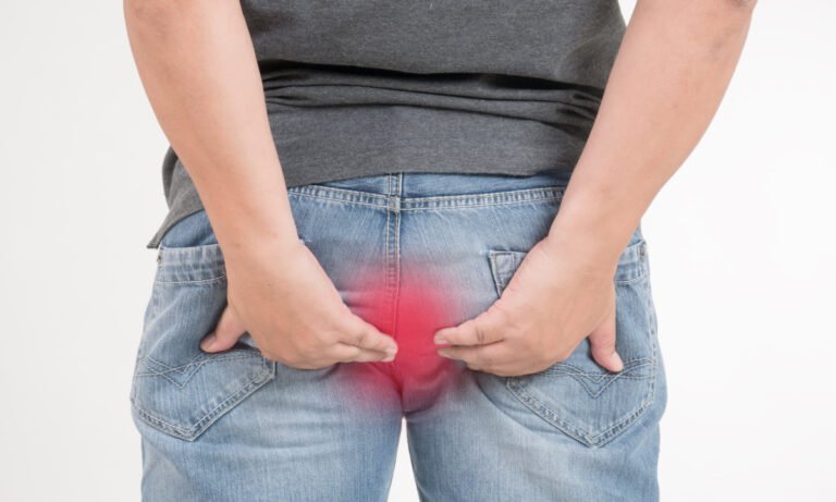 hemotera cara mengempiskan wasir