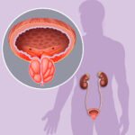prosterafit infeksi saluran kemih pria
