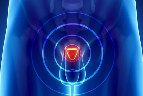 prosterafit gejala prostatitis akut